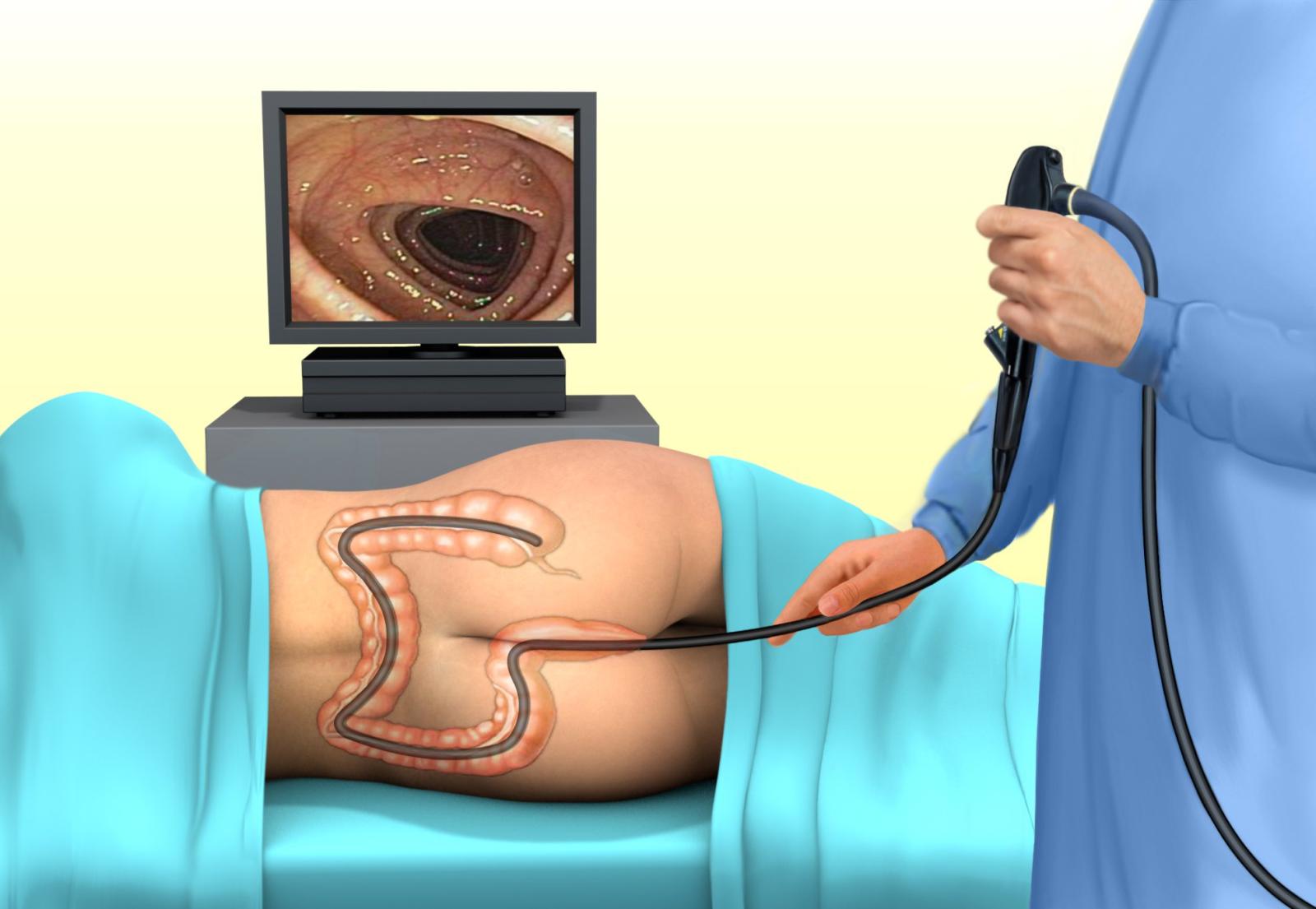 colonoscopy